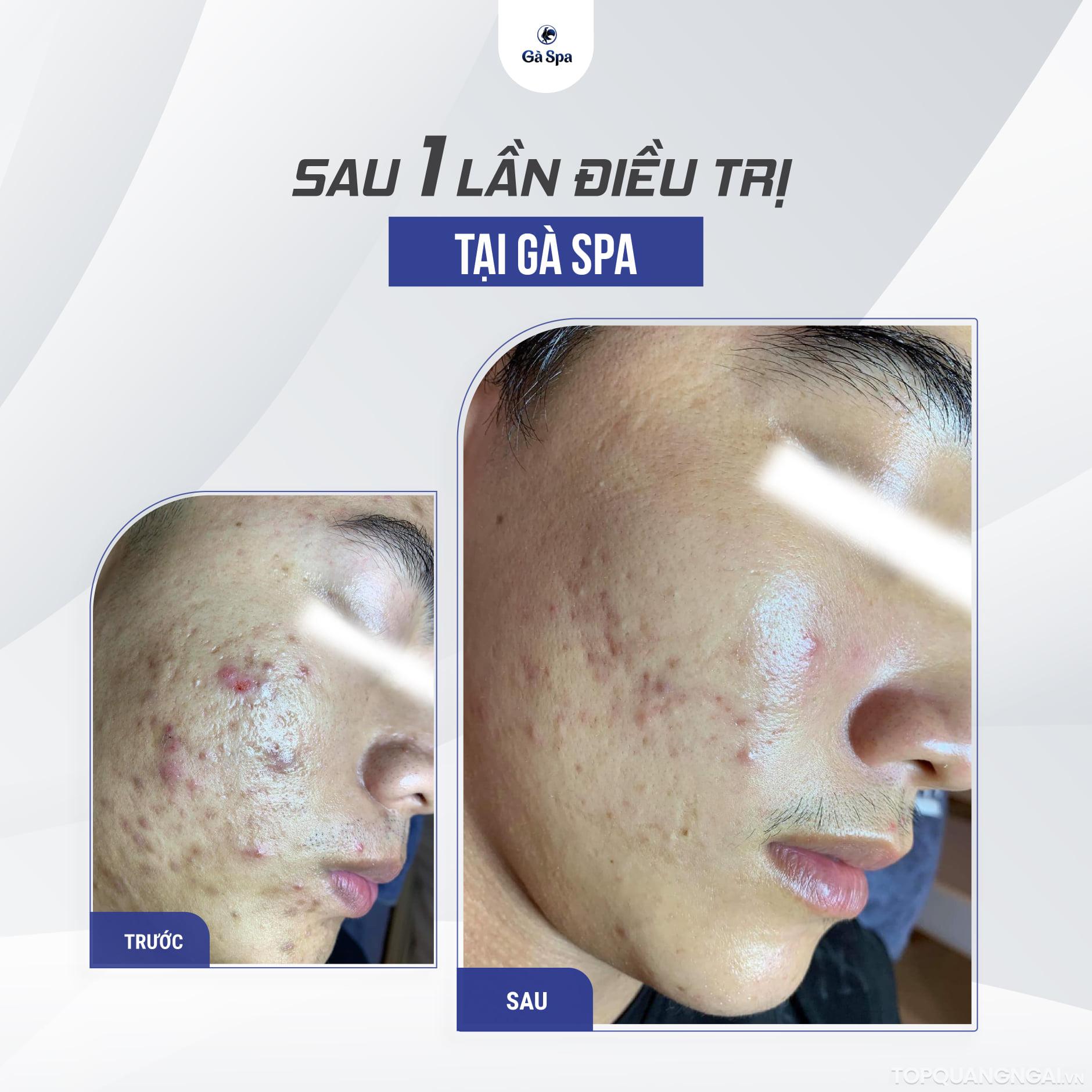 spa trị sẹo rỗ uy tín nhất ở Quảng Ngãi