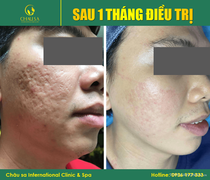 spa trị sẹo rỗ uy tín nhất ở Quảng Ngãi