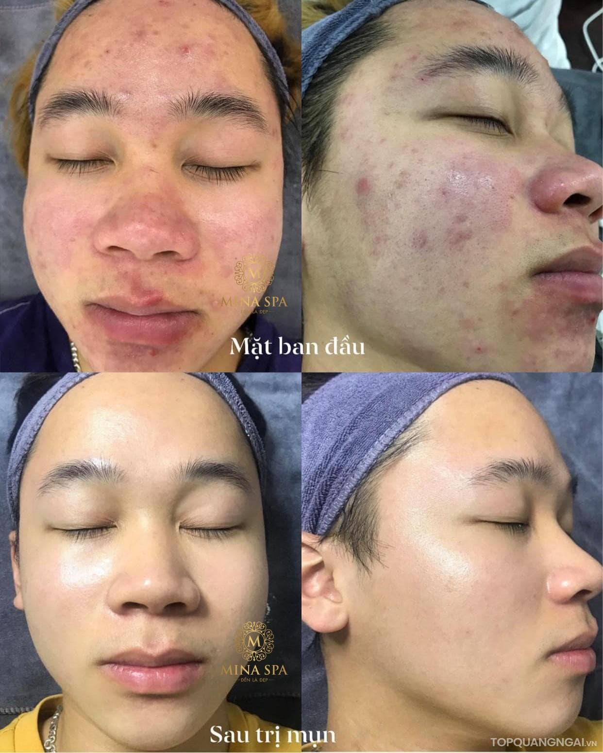 spa trị sẹo rỗ uy tín nhất ở Quảng Ngãi