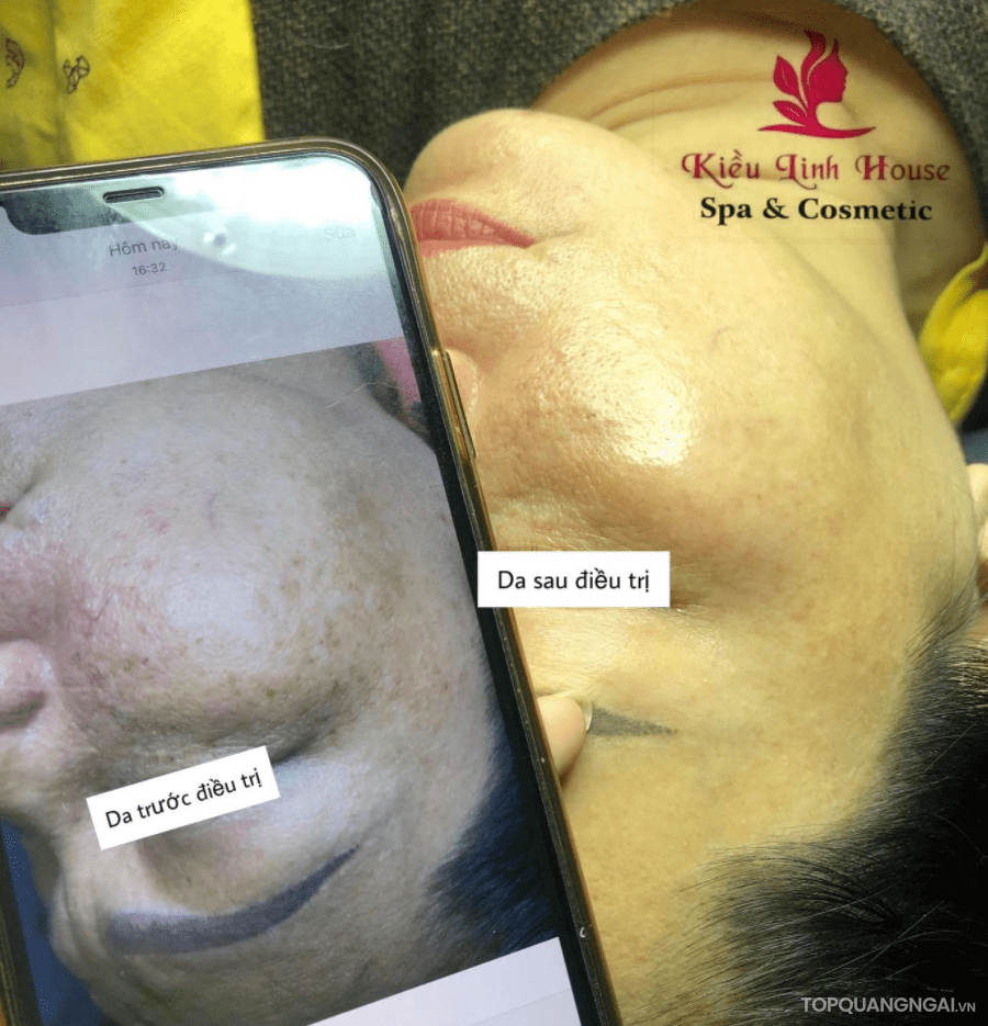 spa tri nam tan nhang quang ngai 4