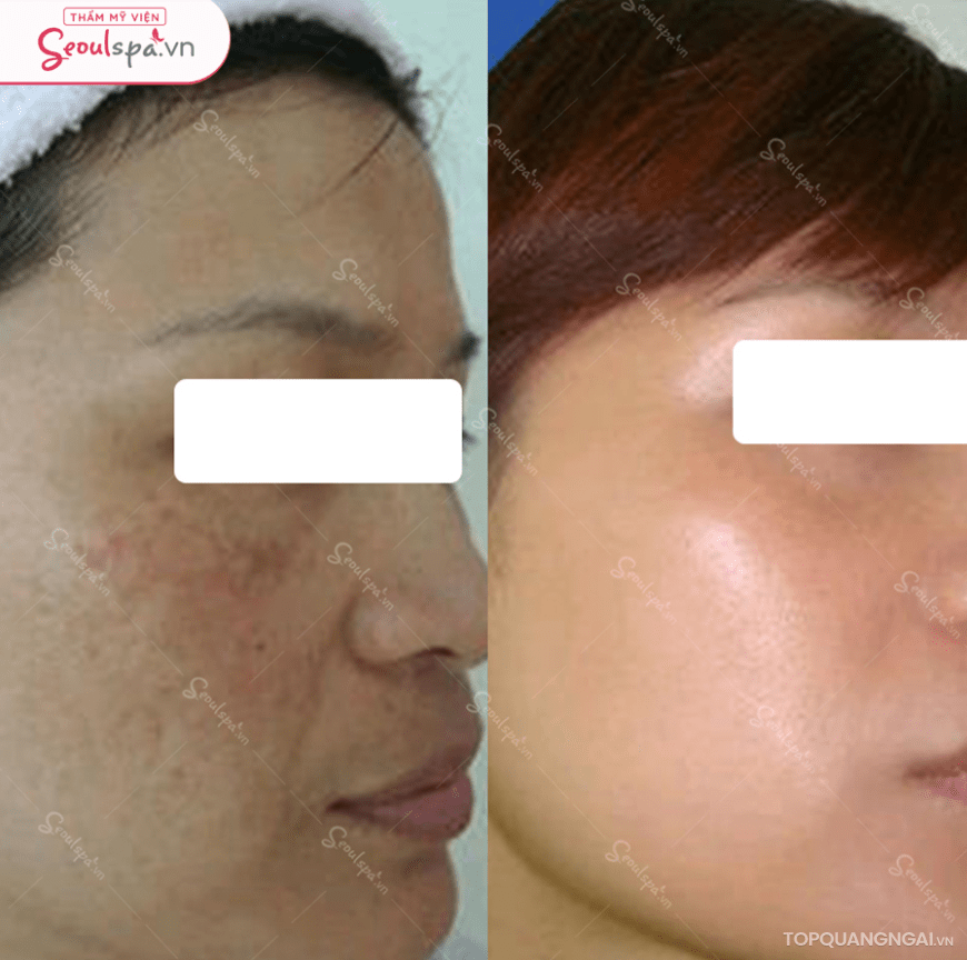 spa tri nam tan nhang quang ngai